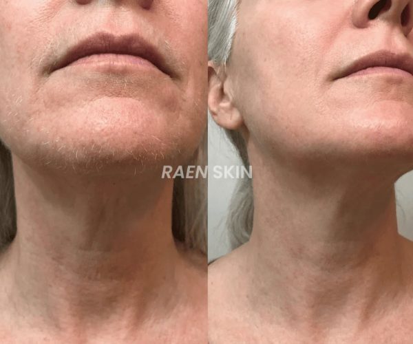 Raen Skin Siero Controllo Ricrescita