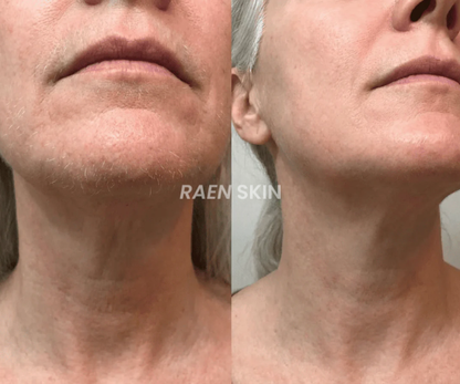 Raen Skin Siero Controllo Ricrescita