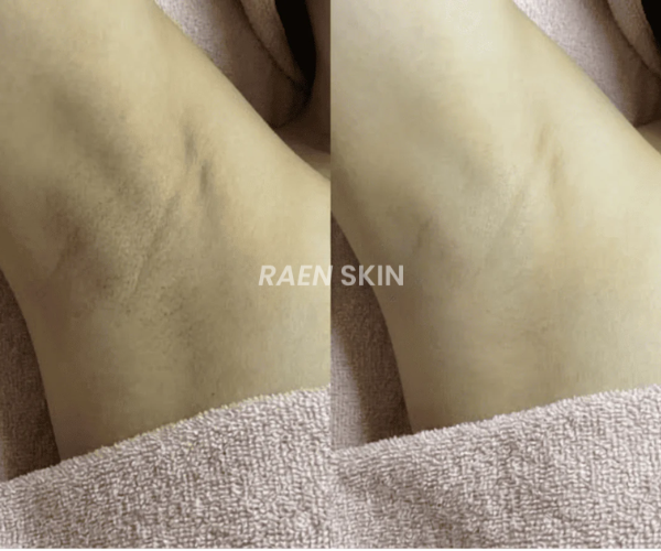 Raen Skin Siero Controllo Ricrescita