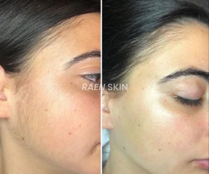 Raen Skin Siero Controllo Ricrescita