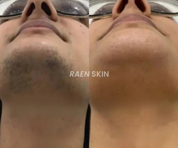 Raen Skin Siero Controllo Ricrescita