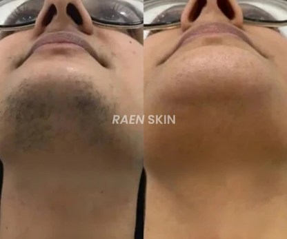 Raen Skin Siero Controllo Ricrescita
