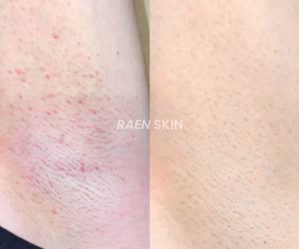 Raen Skin Siero Controllo Ricrescita