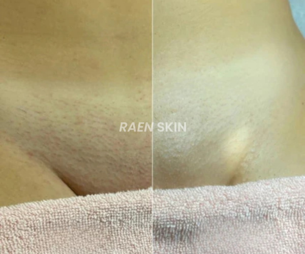 Raen Skin Siero Controllo Ricrescita