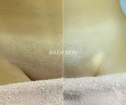 Raen Skin Siero Controllo Ricrescita